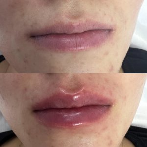 Заполнение губ средней плотности гиалуроновой кислотой для создания естественного объёмаа