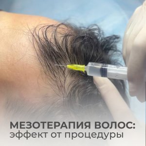 Мезотерапия волос: эффект от процедуры