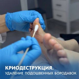 КРИОДЕСТРУКЦИЯ. Удаление подошвенных бородавок