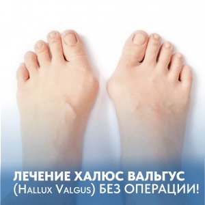 Лечение ХАЛЬГУС ВАЛЬГУС (Hallux Valgus) БЕЗ ОПЕРАЦИИ!