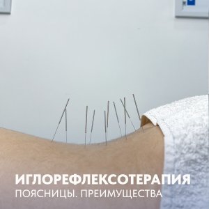 Иглорефлексотерапия поясницы