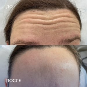 Результаты ботулинотерапии