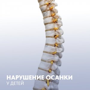 Нарушение осанки у детей.