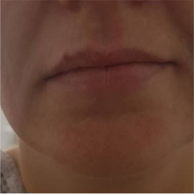 Контурная пластика губ швейцарским препаратом Breeze Derm Volume