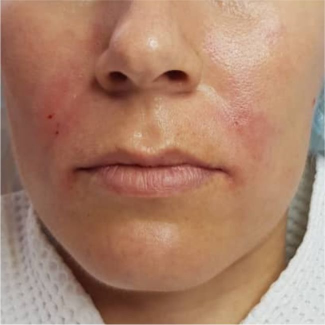 Контурная пластика носогубных складок швейцарским препаратом Breeze Derm Volume